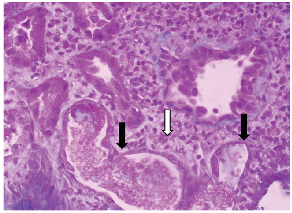 Acute Kidney Injury by Near-drowning: From the Beach to the Hemodialysis Center: A Case Report