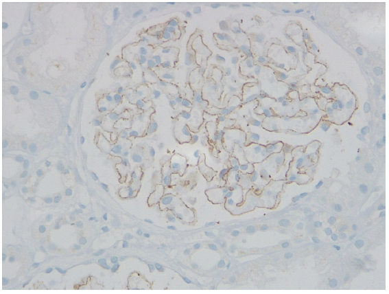 Insights into Therapeutic Strategies and Longitudinal Outcomes: A Retrospective Analysis of NELL1 Positive Membranous Nephropathy Cohort