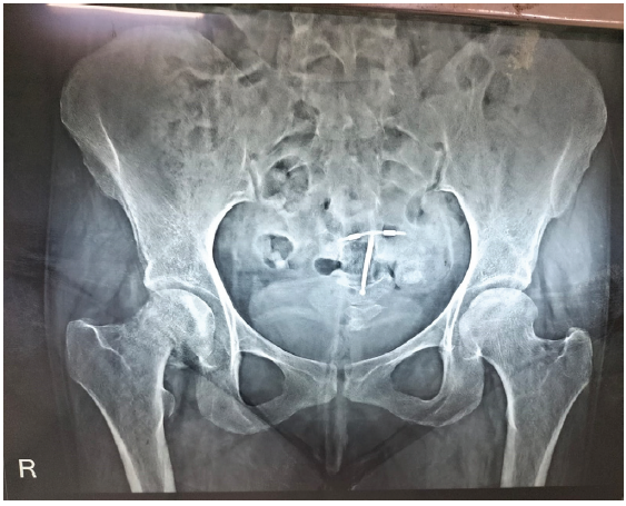 Tenofovir-Induced Fanconi Syndrome Associated with a Fragility Fracture of the Right Femoral Neck