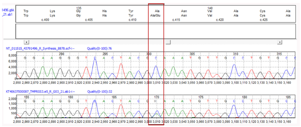 Genetic Rarity: The First Case Report of TMPRSS3 Mutation Coinciding with Multicystic Dysplastic Kidney