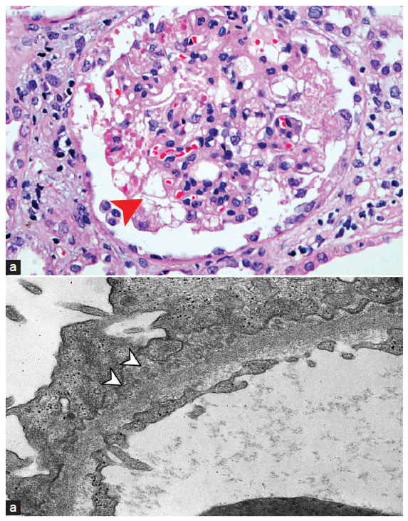 An Unusual Glomerulopathy with Subepithelial Deposits Having Microspherular Structures Following COVID-19 Vaccine