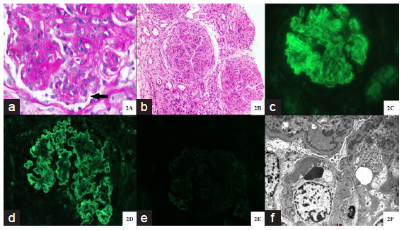 Hemato-Renal Profile of Proliferative Glomerulonephritis with Monoclonal Immunoglobulin Deposits