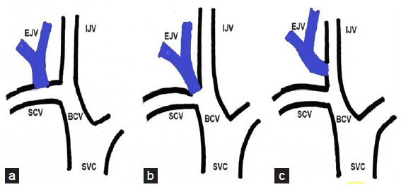 Tunneled Dialysis Catheter Insertion in External Jugular Vein by Nephrologists