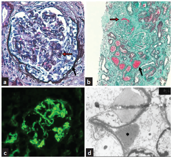 Oral Anticoagulant-Related Nephropathy: A New Cause for an Old Entity