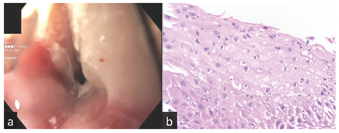 Mycophenolate-Induced Dysphagia in a Kidney Transplant Recipient