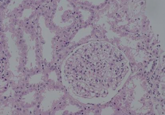 Filariasis-Associated Secondary Membranous Nephropathy: A Rare Presentation