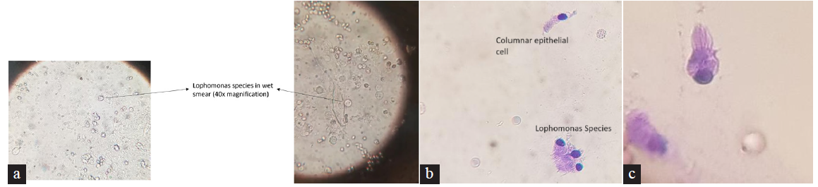 A Rare Parasitic Infection from the Common Cockroach: A Case of Lophomonas Blattarum from a Tertiary Center in Kerala