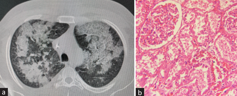 Rhinovirus Pneumonia, Rhabdomyolysis-Induced Acute Kidney Injury, and Post-Viral Forme Fruste Lupus