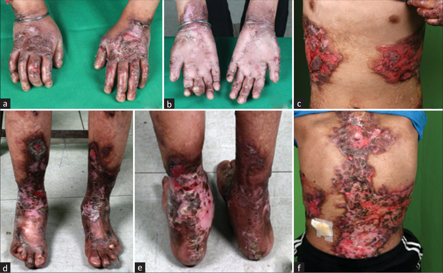 Renal Amyloidosis in a Child with Recessive Dystrophic Epidermolysis Bullosa Due to a Novel Variant in COL7A1 Gene