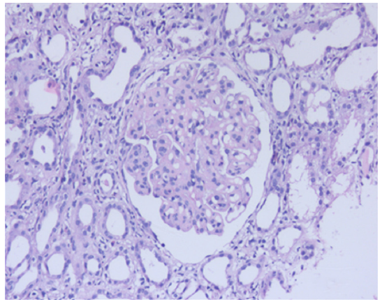 Nerve Epidermal Growth Factor-Like 1 Protein (NELL-1) Expression in Mercury-Related Membranous Nephropathy: Is It a True Association or a Chance Occurrence?