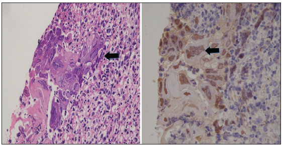 Herpes Simplex Virus Type-2 Nephritis: An Unexpected Plot Twist in a Kidney Transplant Recipient