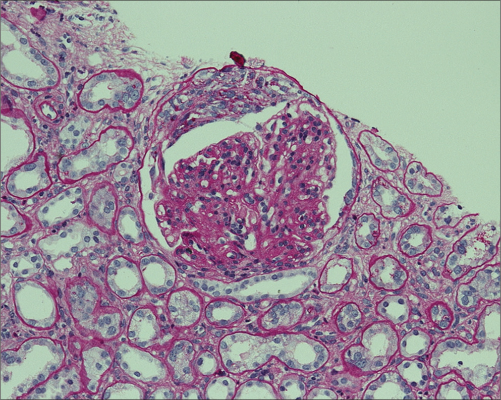 Evolution of Proliferative Glomerulonephritis with Monoclonal Immunoglobulin Deposits Over a Decade