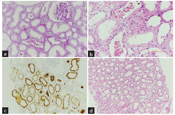 Rhabdomyolysis and Pigment Nephropathy – An Uncommon Manifestation of Eucalyptus Oil Consumption