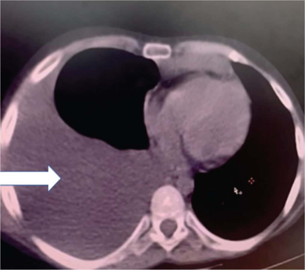 A Mysterious Case of Pleuroperitoneal Leak Leading to Recurrent Hydrothorax in a Child with Nephrotic Syndrome