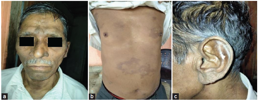 Immune-Mediated Glomerulonephritis as Type 2 Lepra Reaction Posttreatment of Lepromatous Leprosy: A Case Report