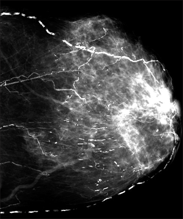 Relapsing Calciphylaxis of the Breast: Glucocorticoids – Friend or Foe?