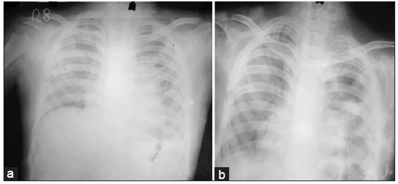 Rituximab Induced Rare Cystic Lesion in Lungs in a Nephrotic Child: A Case Report