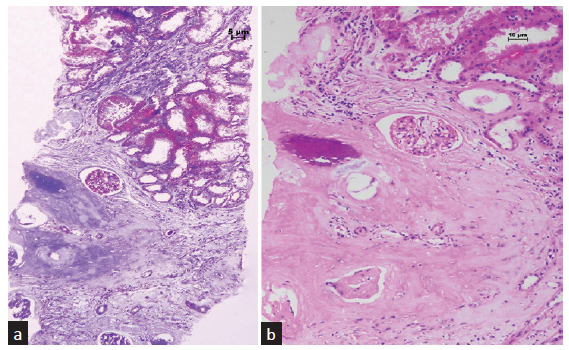 Osseous Metaplasia in Renal Allograft