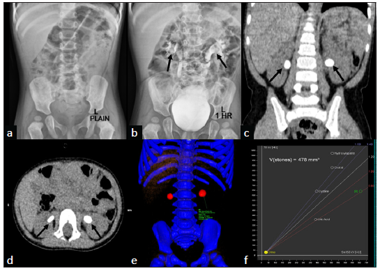 Radiolucent Calculi in Kidneys on Intravenous Urography: Red Color on Dual-Energy Computed Tomography Clinches the Final Diagnosis