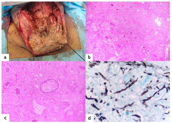 Acute Invasive Fungal Thyroiditis – A Catastrophic Event Post-Renal Transplant