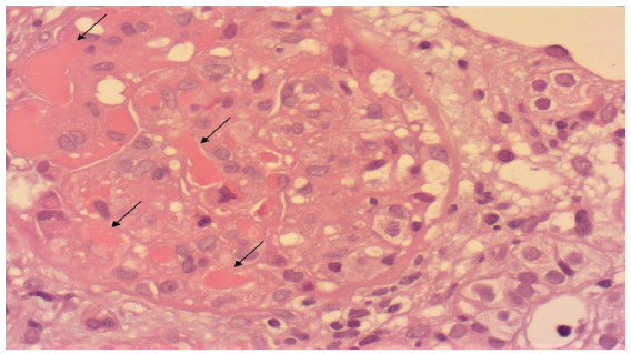 An Unusual Case of Cryoglobulinemic Glomerulonephritis Revealing Waldenstrom’s Macroglobulinemia