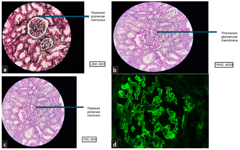 Membranous Nephropathy in a Treatment Naïve Patient of Rheumatoid Arthritis