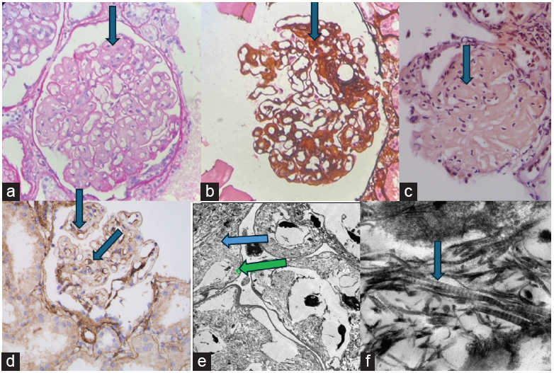 Collagenofibrotic Glomerulopathy—An Unexpected Finding in a Young Female