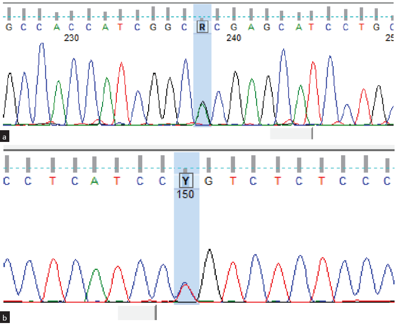 Novel Variations in KIRREL1 Gene and Infantile Onset Nephrotic Syndrome