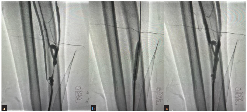 Outcomes of Endovascular Treatment for Salvaging Failed Hemodialysis Arteriovenous Fistula – Role of Balloon Angioplasty as Initial Therapy