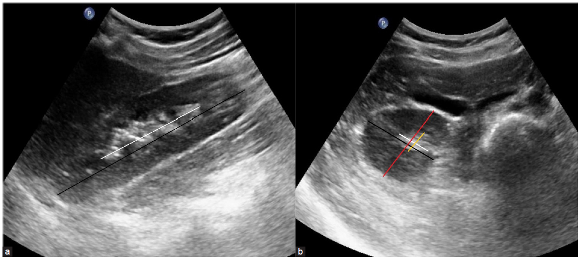 Kidney Dimensions and its Correlation with Anthropometric Parameters in Healthy North Indian Adults