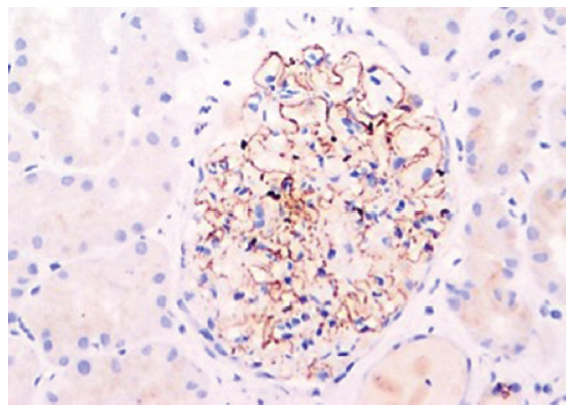 NELL-1 Associated Membranous Nephropathy - A Case Series from India