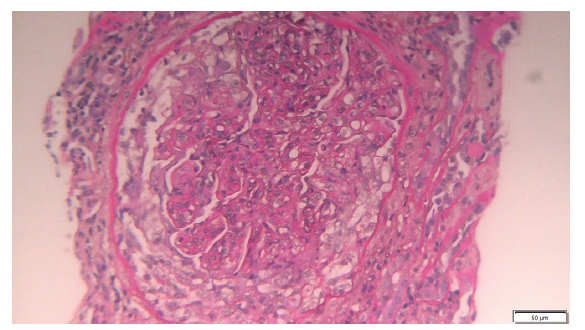 C3 Glomerulonephritis Associated with Monoclonal Gammopathy