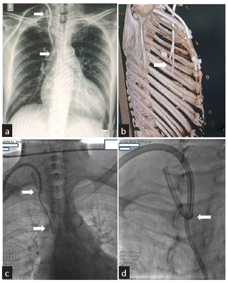 Delayed Malposition of a Split-Tip Tunneled Cuffed Hemodialysis Catheter