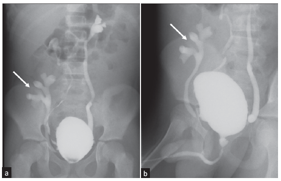 Trilateral Reflux in a Child with Renal Transplant