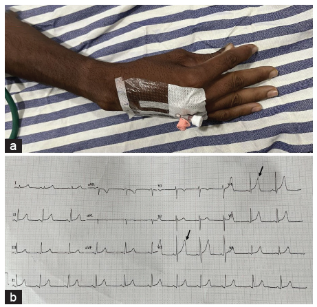 Tetany in a Patient with Gastroesophageal Reflux Disease