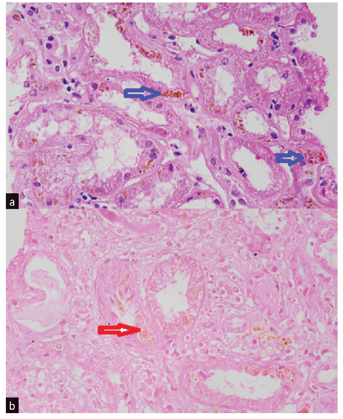 Lipofuscin Deposition in the Kidney: Damaging or Deceiving?