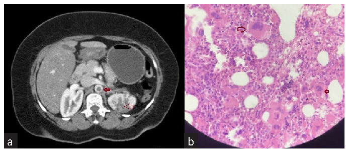 Acute Renal Infarction – A Rare Thrombotic Complication in Essential Thrombocytosis