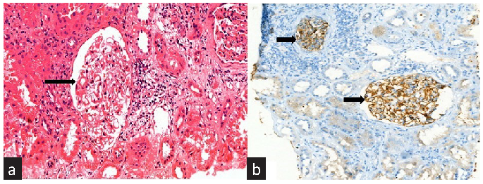 Post Transplant Membranous Nephropathy: A 10-year Single-Centre Experience