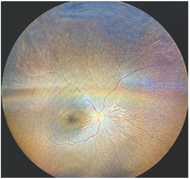 Senior-Loken Syndrome: A Rare Cause of End Stage Kidney Disease in a Child