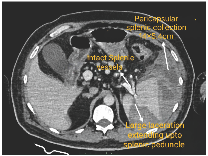 Conservatively Managed Spontaneous Splenic Rupture in a Hemodialysis Patient