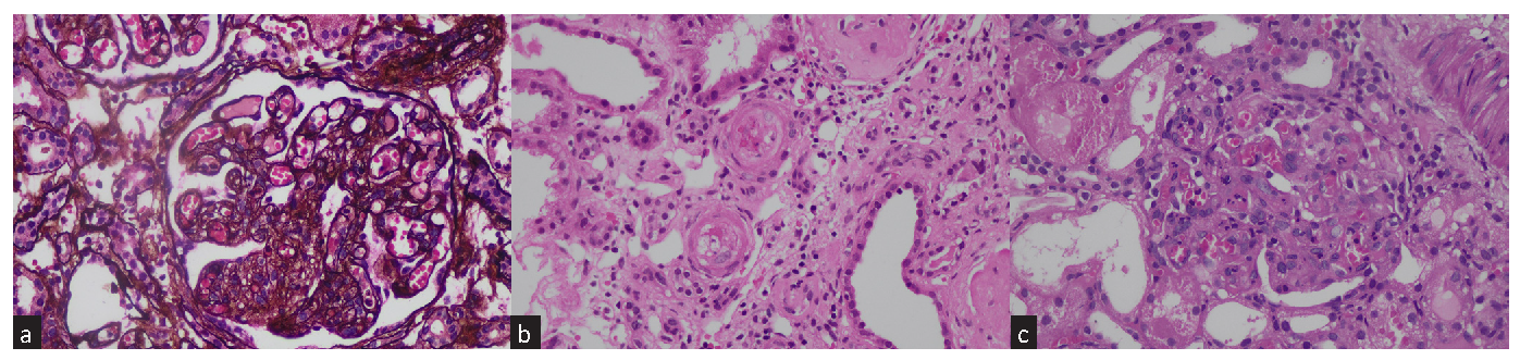 Clinical Profile and Outcomes of Thrombotic Microangiopathy: A Kidney Biopsy Registry Cohort