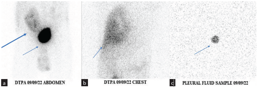 Urinothorax in a Late Kidney Transplant Following Graft Biopsy