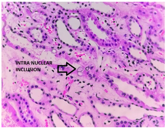 Disseminated Adenovirus Infection in Renal Transplant Recipients
