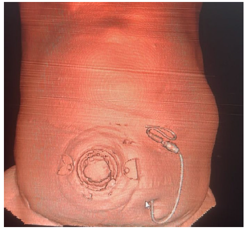 Continuous Ambulatory Peritoneal Dialysis in a Patient with Colostomy