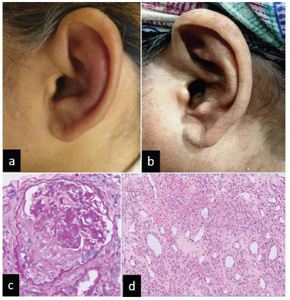 Auricular Chondritis and Renal Medullary Angiitis – An Uncommon Manifestation of Antineutrophilic Cytoplasmic Antibody Associated Vasculitis