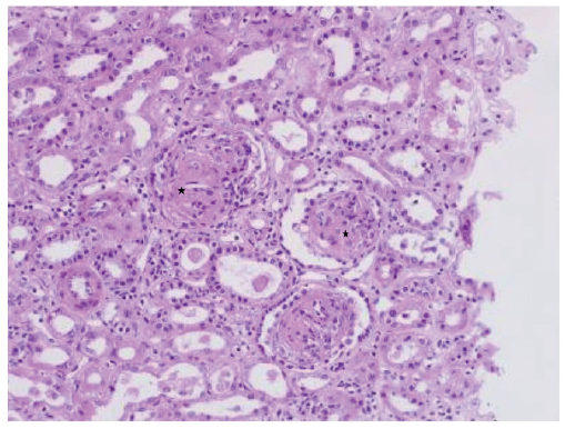 Novel TRPV4 Gene Mutation and Diffuse Mesangial Sclerosis in Steroid Resistant Nephrotic Syndrome