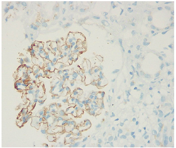 NELL-1 as a Target Antigen in Asbestosis Associated Membranous Nephropathy — A Case Report