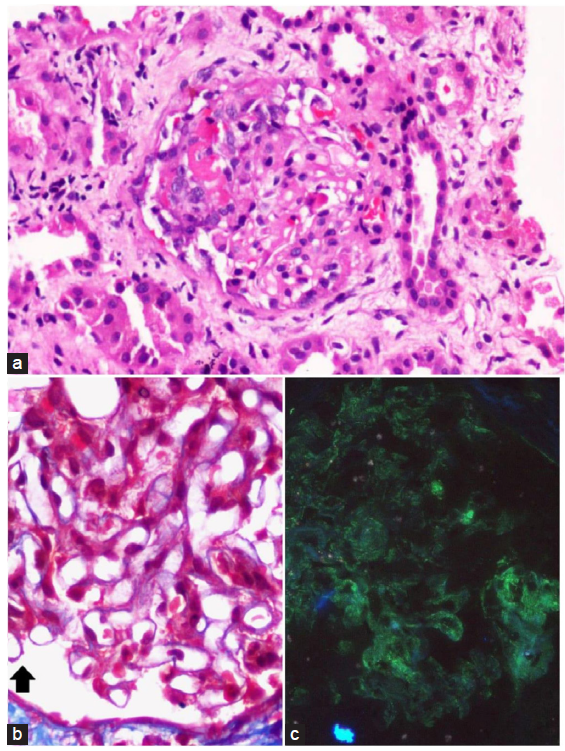 Concomitant Histological Features of Membranous Nephropathy and Anti-Neutrophil Cytoplasmic Antibody Associated Vasculitis