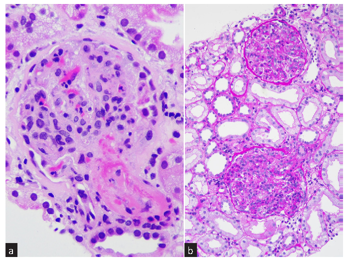 Rare Histologic Coexistence of Infection-Related Glomerulonephritis and Thrombotic Microangiopathy