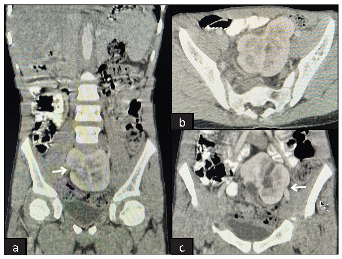 Pancake Kidney: A Rare Case of Renal Ectopia